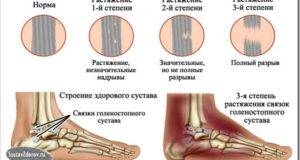 Повреждения связок голеностопа