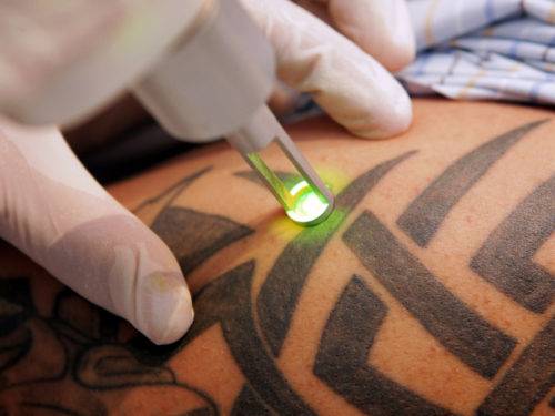Как удалить татуировку без шрама 